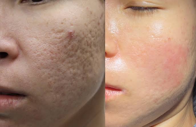 Acne Scar Treatments Effective Treatment Methods That Can Permanently Reduce Your Acne Scars