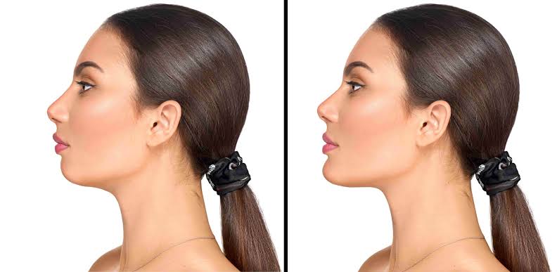 Chin Correction Surgery Procedure Benefits Recovery and Results