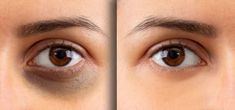 Home Remedies vs Professional Dark Circle Treatment Which One Works Better