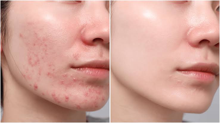 Laser Acne Treatment Benefits Procedure Recovery and Results