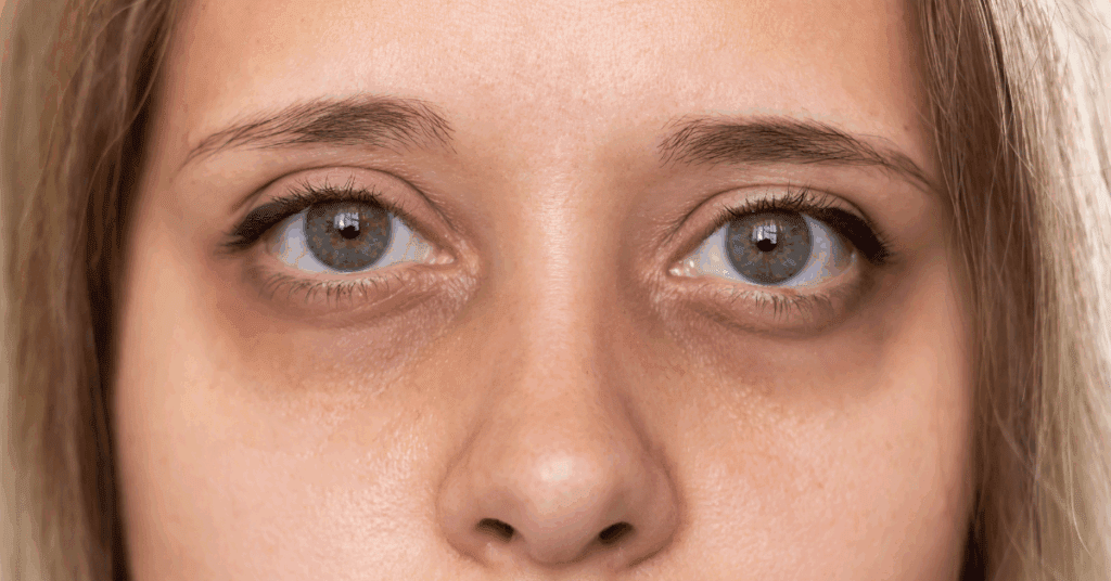 Top Treatments for Dark Circles Lasers PRP Fillers and Chemical Peels