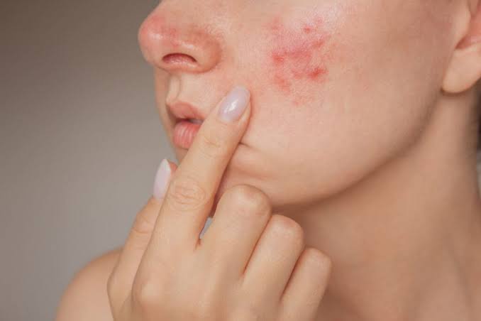 What Causes Acne Signs Variants and the Best Care Choices