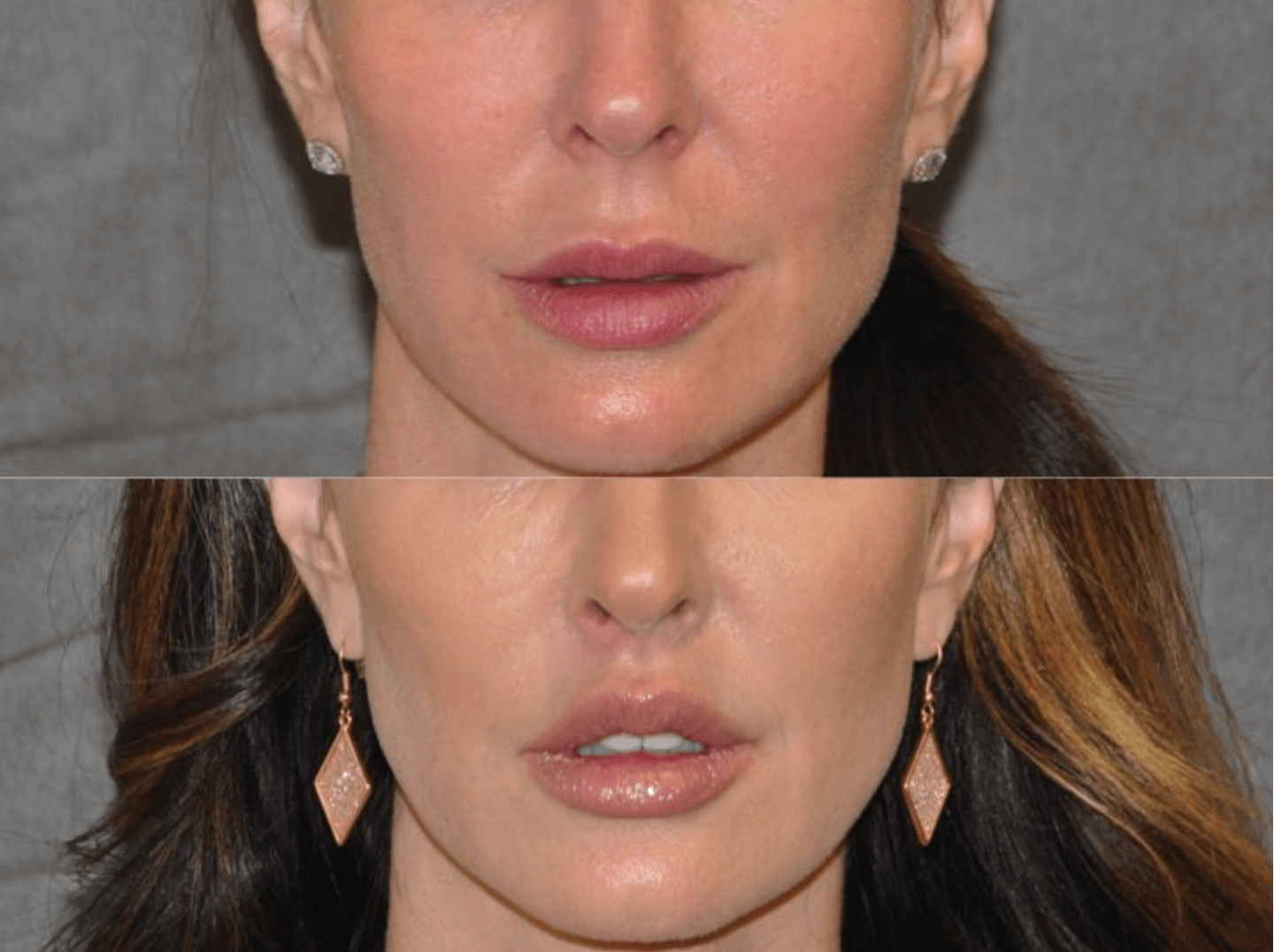 Achieve a Youthful Smile with Lip Lift Surgery in Jaipur