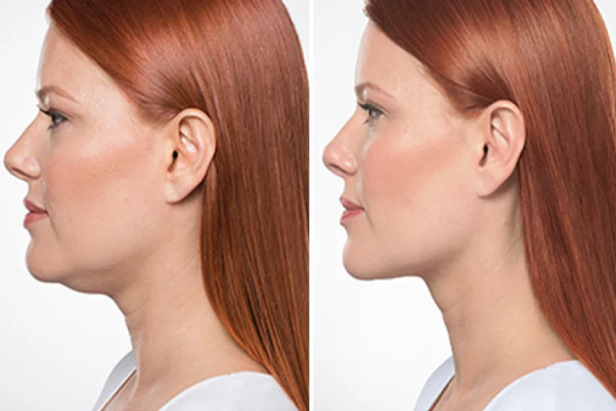 Chin Correction Surgery What It Does Why People Choose It and What to Expect