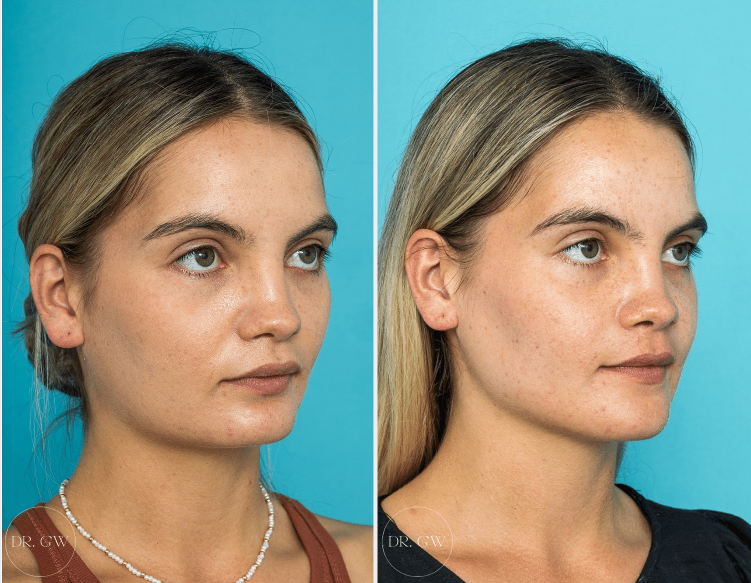 Chin Implant Surgery in Jaipur Add Value to Facial Symmetry in Complete Peace and Confidence
