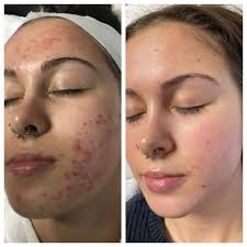 Acne Treatment in Sri Ganganagar