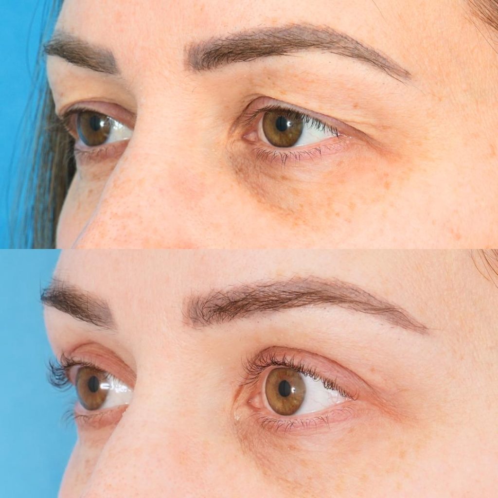 Blepharoplasty in Sri Ganganagar