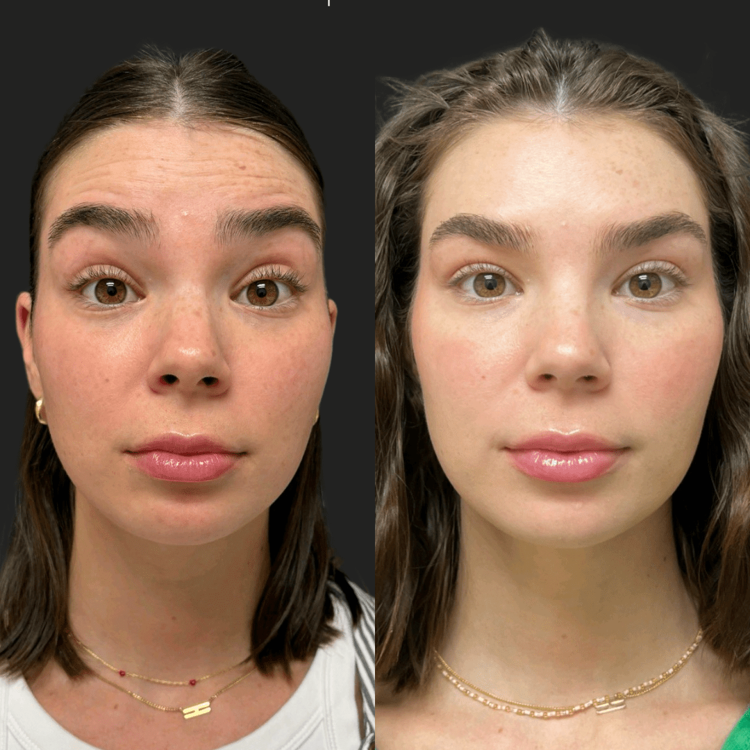 Botox in Sri Ganganagar