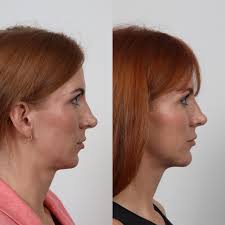 Chin Implant in Sri Ganganagar