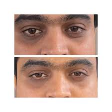 Dark Circles Treatment in Sri Ganganagar