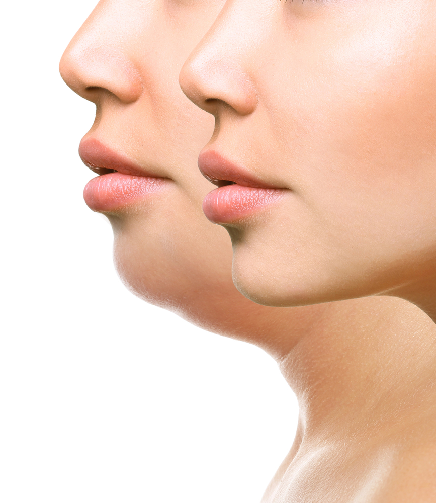 Double Chin Correction in Sri Ganganagar