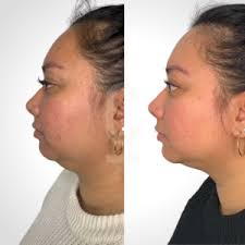 Double Chin Reduction in Sri Ganganagar