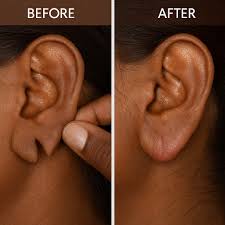 Ear Lobe Repair in Sri Ganganagar