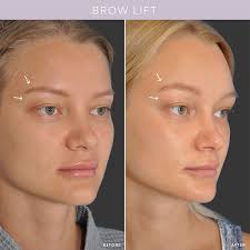 Eyebrow Lift in Sri Ganganagar