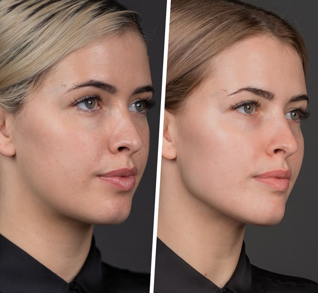 Face Contouring Treatment in Sri Ganganagar