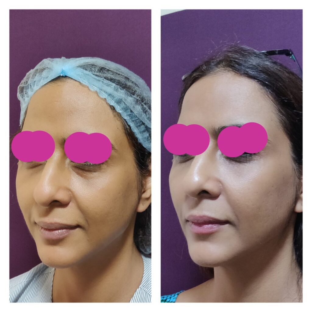 Face Fat Grafting in Sri Ganganagar