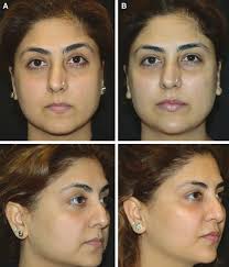 Face Features Correction in Sri Ganganagar