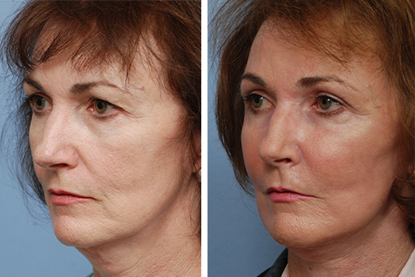 Facial Implant in Sri Ganganagar