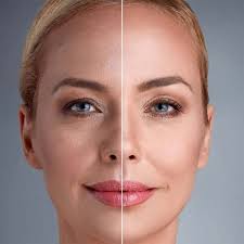 Facelift Surgery in Sri Ganganagar