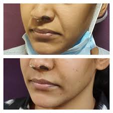 Fat Grafting in Sri Ganganagar