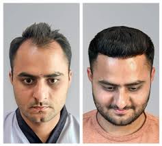 Hair Transplant in Sri Ganganagar