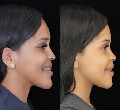 Jaw Correction in Sri Ganganagar