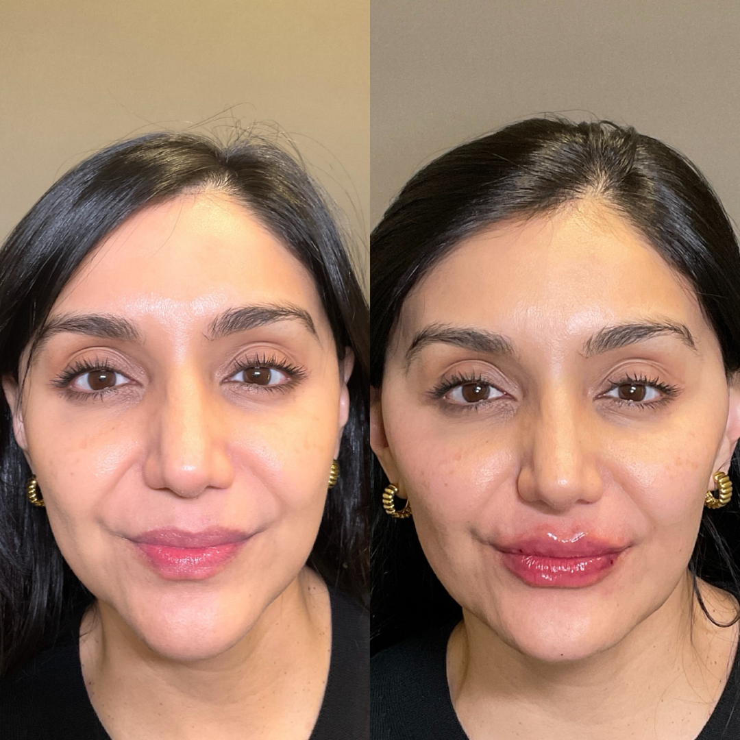 Jaw Line Correction in Bikaner