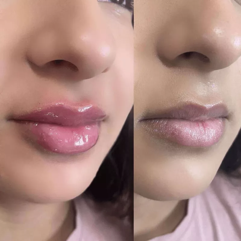 Lip Filler in Sri Ganganagar
