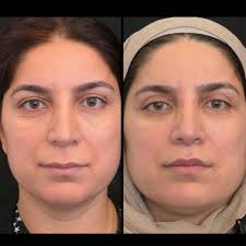Lip Lift in Sri Ganganagar