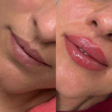 Lip Makeover Treatment in Sri Ganganagar
