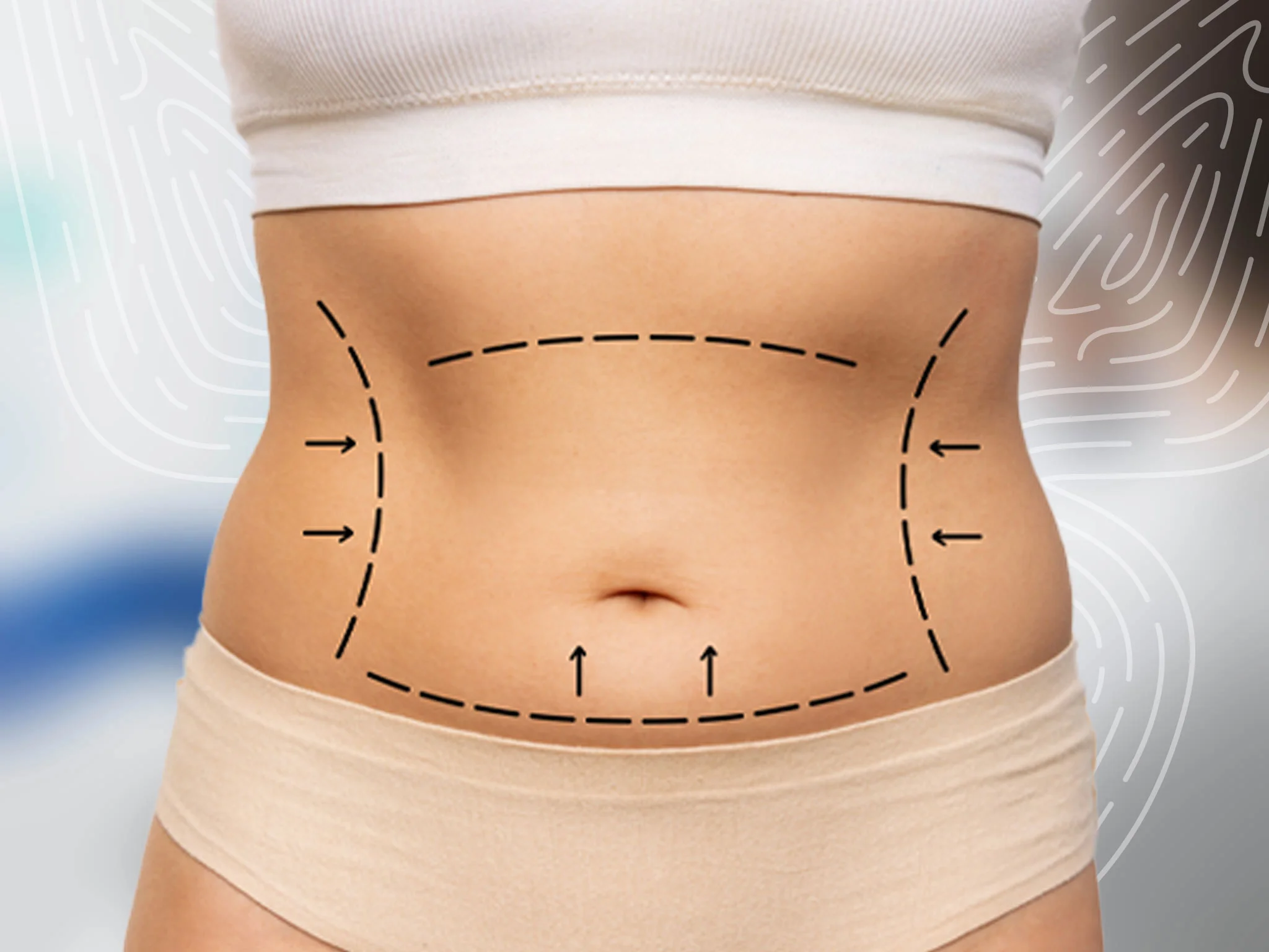 Liposuction in Sri Ganganagar