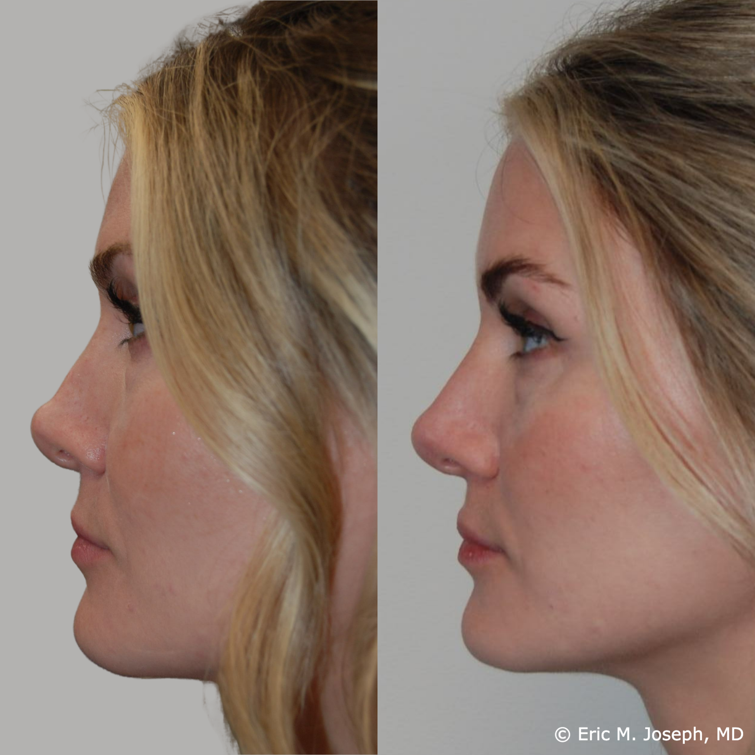 Non Surgical Permanent Face Makeover in Sri Ganganagar