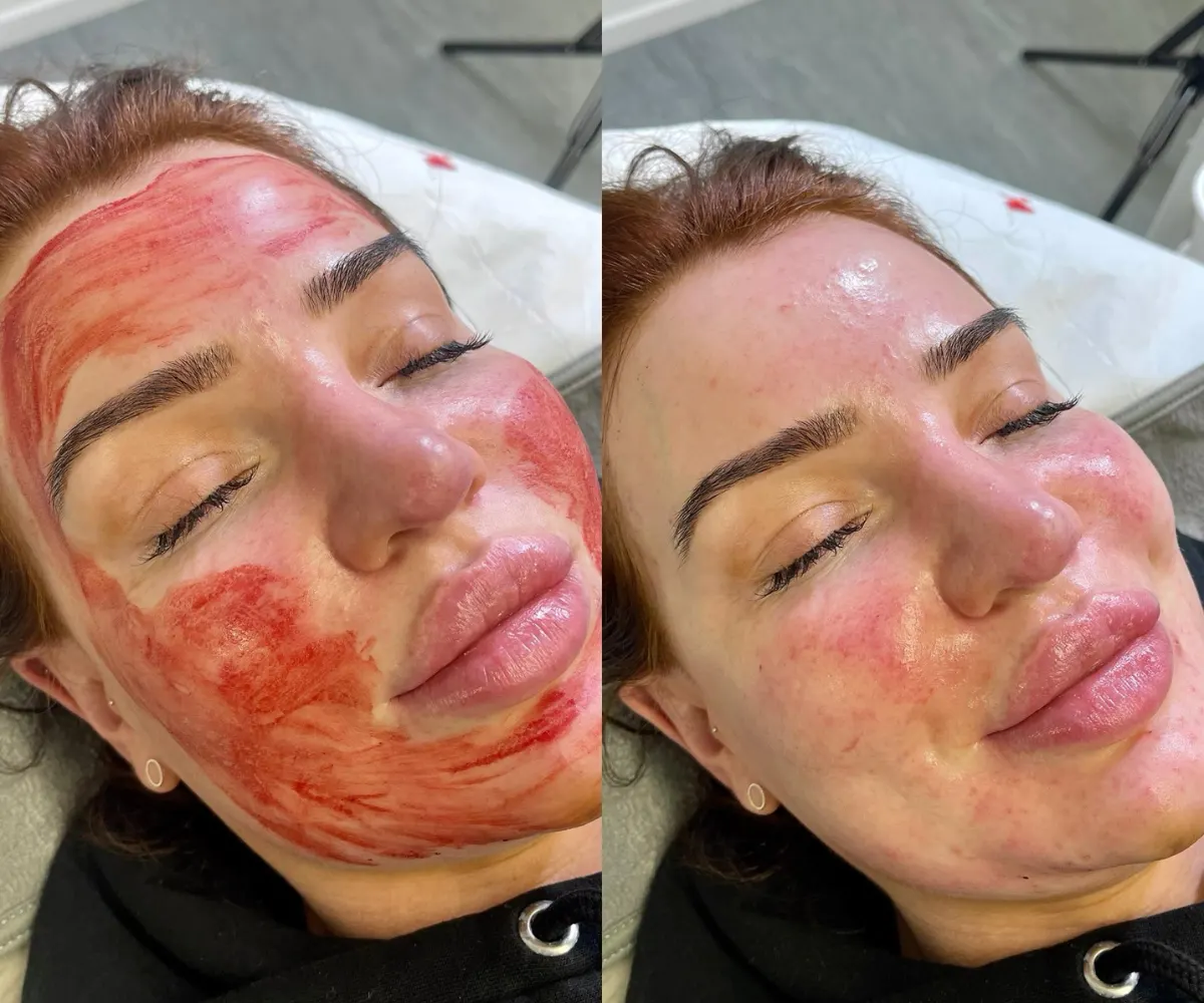 PRP Therapy in Sri Ganganagar