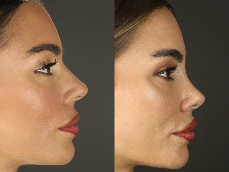 Rhinoplasty in Sri Ganganagar