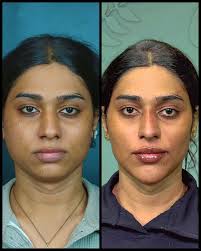 Surgical Face Makeover in Sri Ganganagar