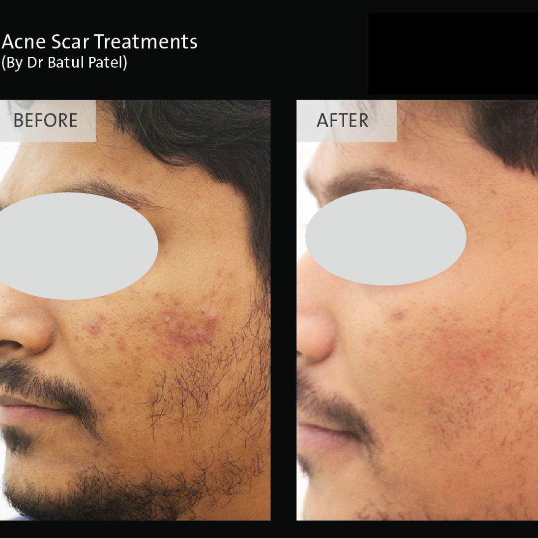 Acne Treatment in Sri Ganganagar