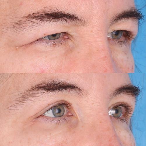 Blepharoplasty in Sri Ganganagar