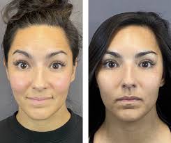 Botox in Sri Ganganagar