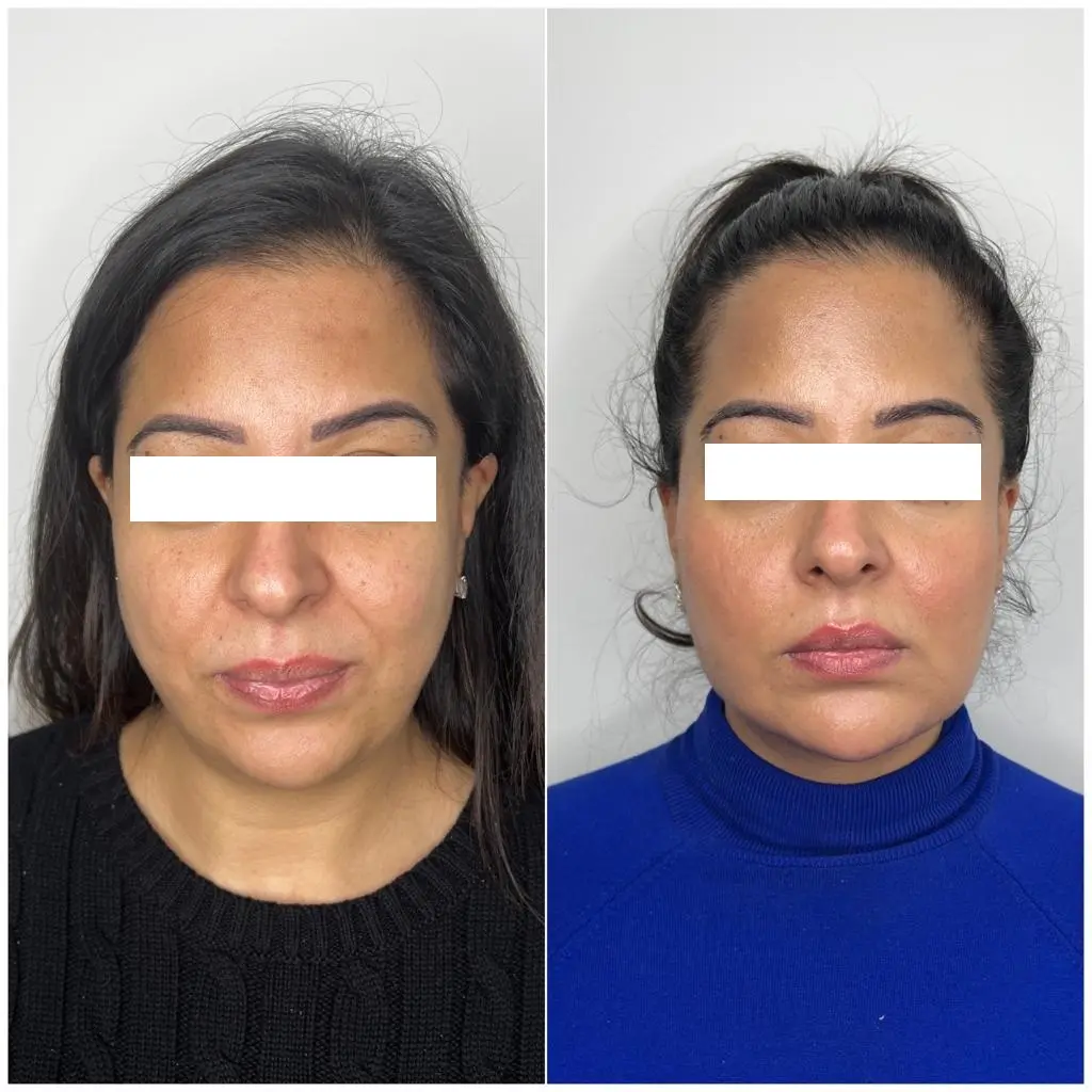 Chin Correction in Sri Ganganagar