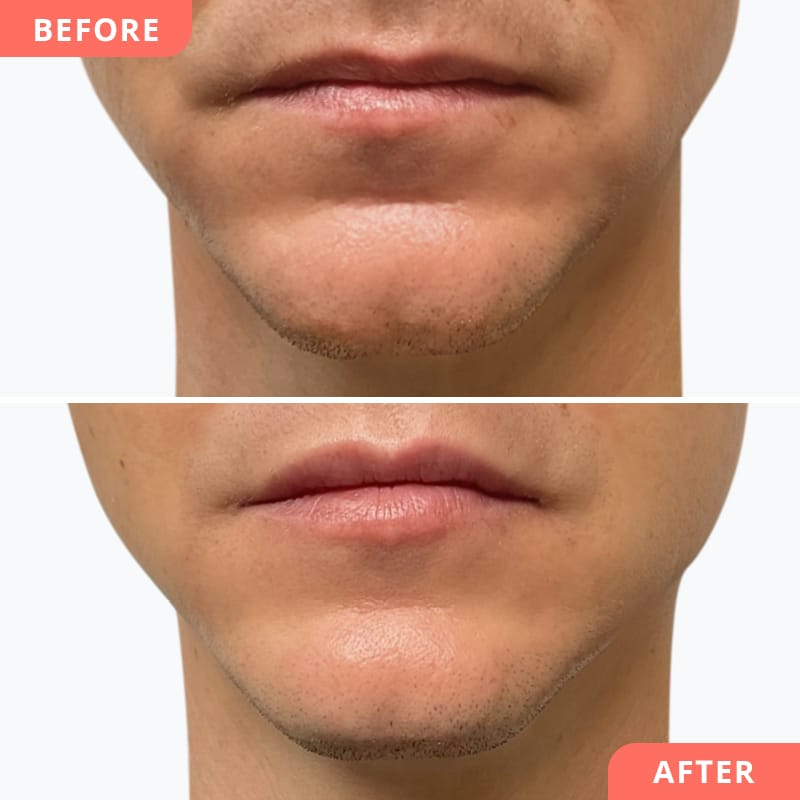 Chin Correction in Sri Ganganagar