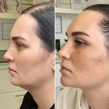 Chin Implant in Sri Ganganagar