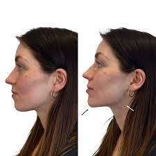 Chin filler in Sri Ganganagar