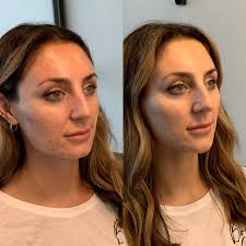 Chin filler in Sri Ganganagar