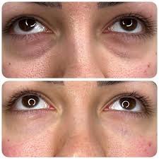 Dark Circles Treatment in Sri Ganganagar