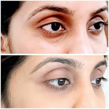 Dark Circles Treatment in Sri Ganganagar