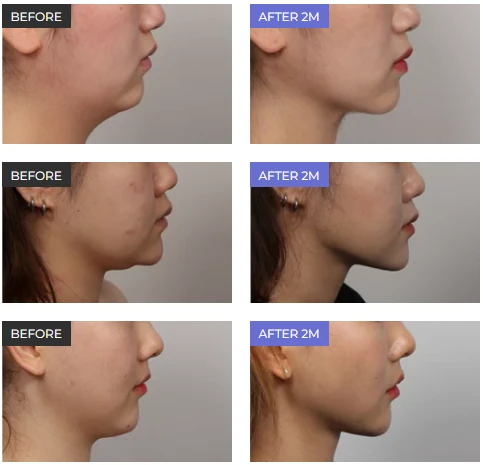 Double Chin Correction in Sri Ganganagar