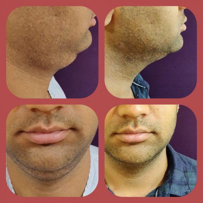 Double Chin Correction in Sri Ganganagar