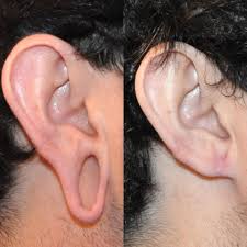 Ear Lobe Repair in Sri Ganganagar
