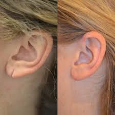 Ear Lobe Repair in Sri Ganganagar
