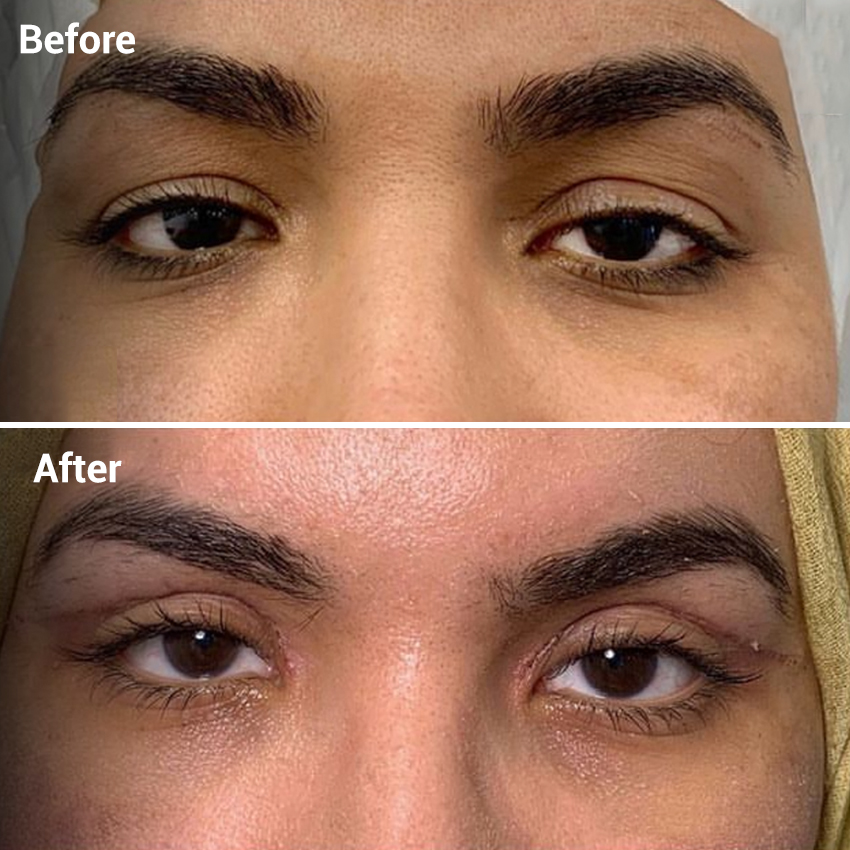 Eyebrow Lift in Sri Ganganagar